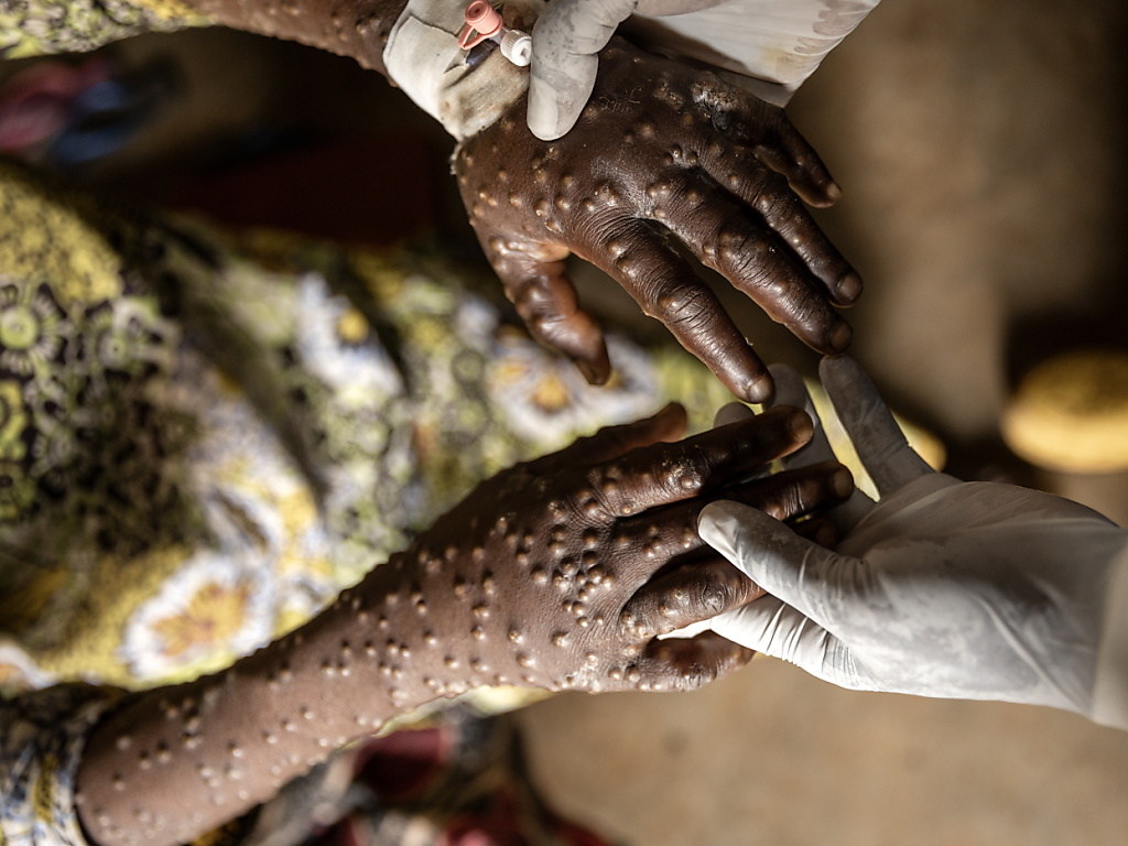 Sénégal : un premier cas de Mpox confirmé à Dakar